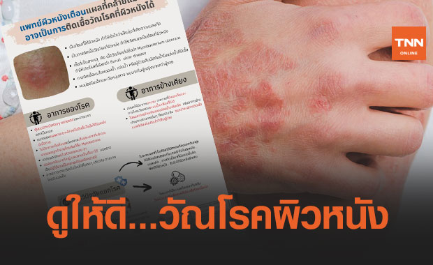 แพทย์ผิวหนังเตือน! แผลที่คล้ายแมลงกัด อาจเป็นการติดเชื้อวัณโรคที่ผิวหนังได้