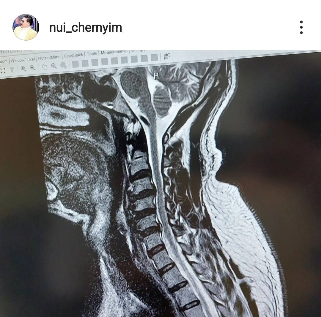 หมอนรองกระดูกคออักเสบเรื้อรัง!! หมอวินิจฉัยแล้วเหตุ นุ้ย เชิญยิ้ม โร่ไปโรงพยาบาล