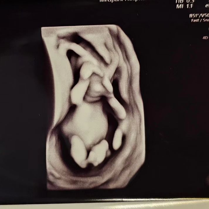 หนุ่ม กรรชัย เผย ได้คุยกับ ตูน บอดี้สแลม เรื่องเพศลูกคนที่ 2 แล้ว