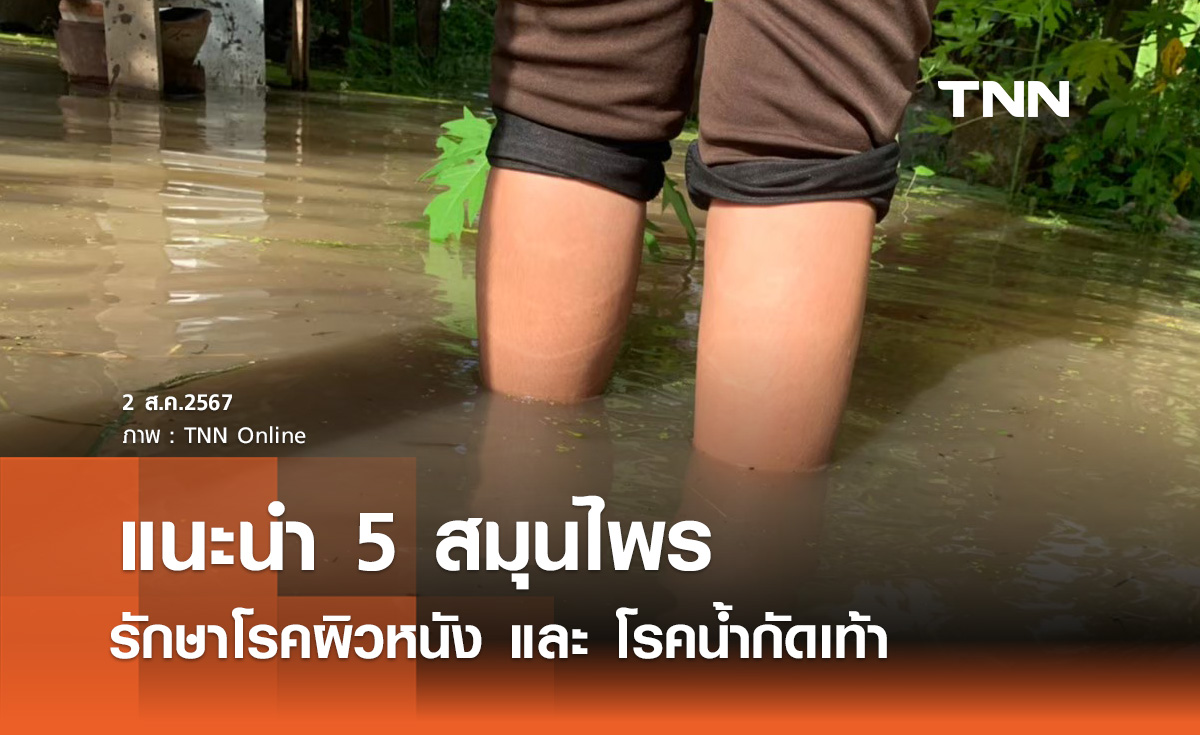 แนะ 5 สมุนไพร รักษาอาการ "โรคผิวหนัง - น้ำกัดเท้า" ช่วงฤดูฝน