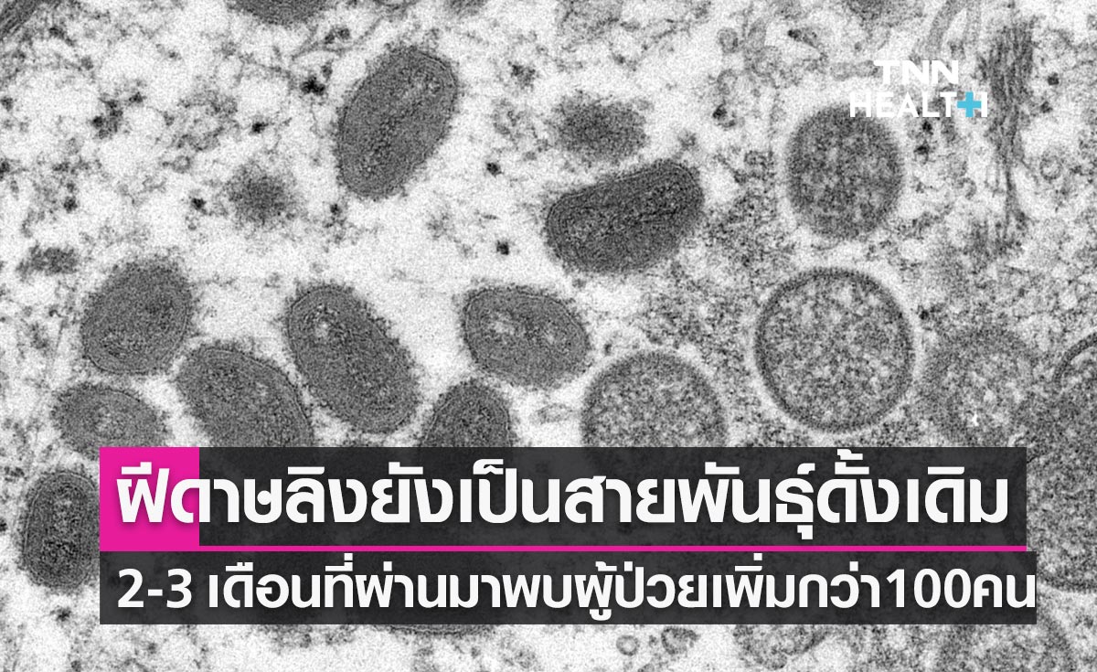 ฝีดาษลิงในไทย! ยังเป็นสายพันธุ์ดั้งเดิม 2-3 เดือนที่ผ่านมาพบผู้ป่วยเพิ่มกว่า 100 คน