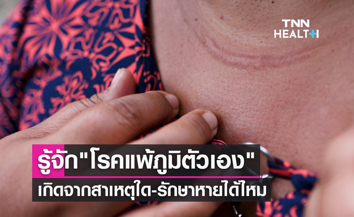 "โรคแพ้ภูมิตัวเอง" เกิดจากสาเหตุใด-รักษาหายได้ไหม-อาการเป็นอย่างไร