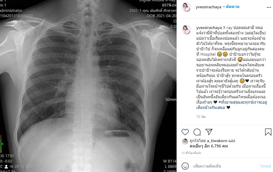 อัปเดตอาการ ต้อย เศรษฐา มีรอยที่ปอดด้านล่างขวา 3 ซม.