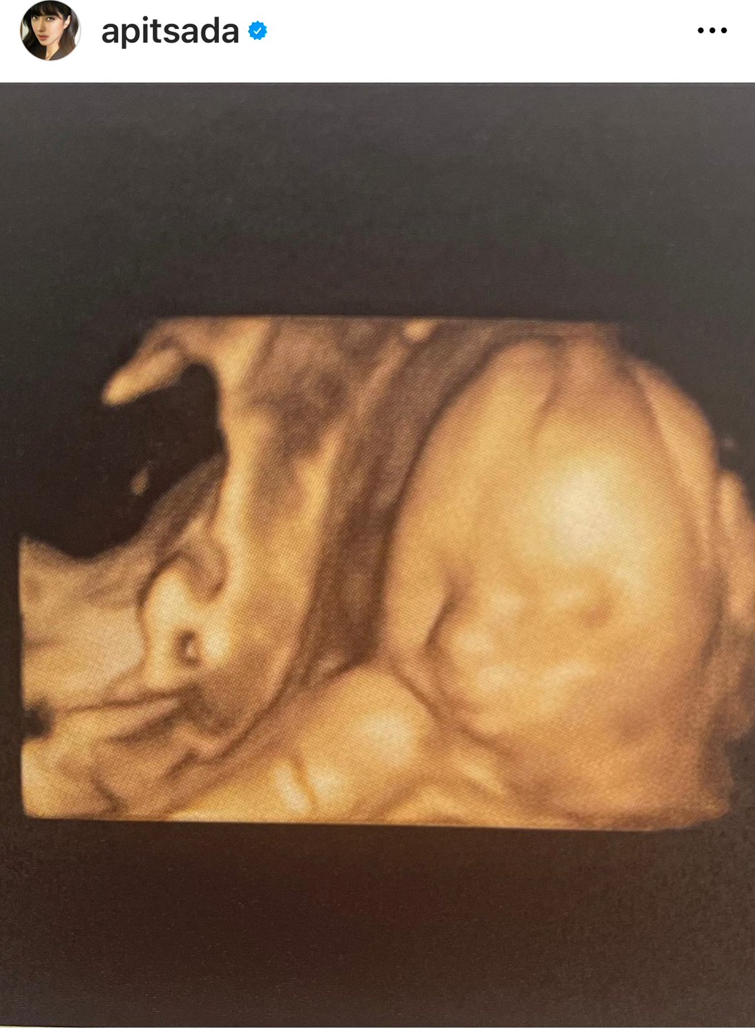 ไอซ์ อภิษฎา โชว์ภาพอัลตราซาวด์ 8 เดือน แฟนๆ แห่คอมเมนต์จมูกโด่งมาแต่ไกล ไอซ์ อภิษฎา โชว์ภาพอัลตราซาวด์ 8 เดือน แฟนๆ แห่คอมเมนต์จมูกโด่งมาแต่ไกล