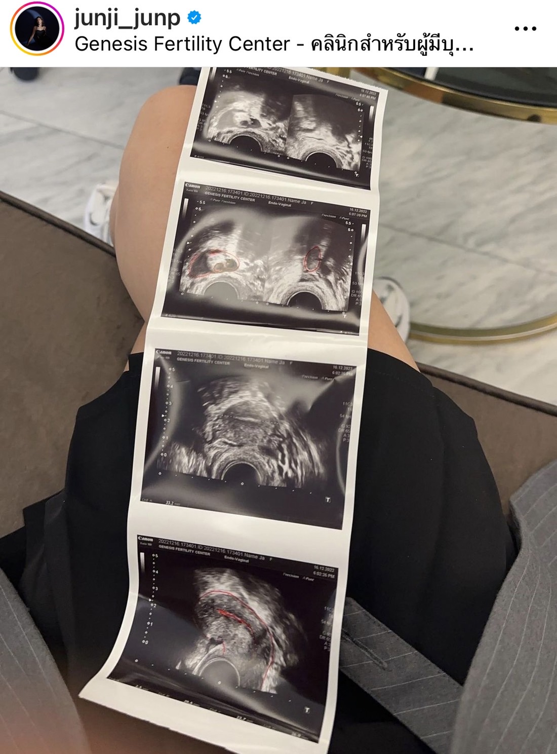 จันจิ รีวิวการฝากไข่ เตรียมพร้อมสำหรับอนาคต จันจิ รีวิวการฝากไข่ เตรียมพร้อมสำหรับอนาคต