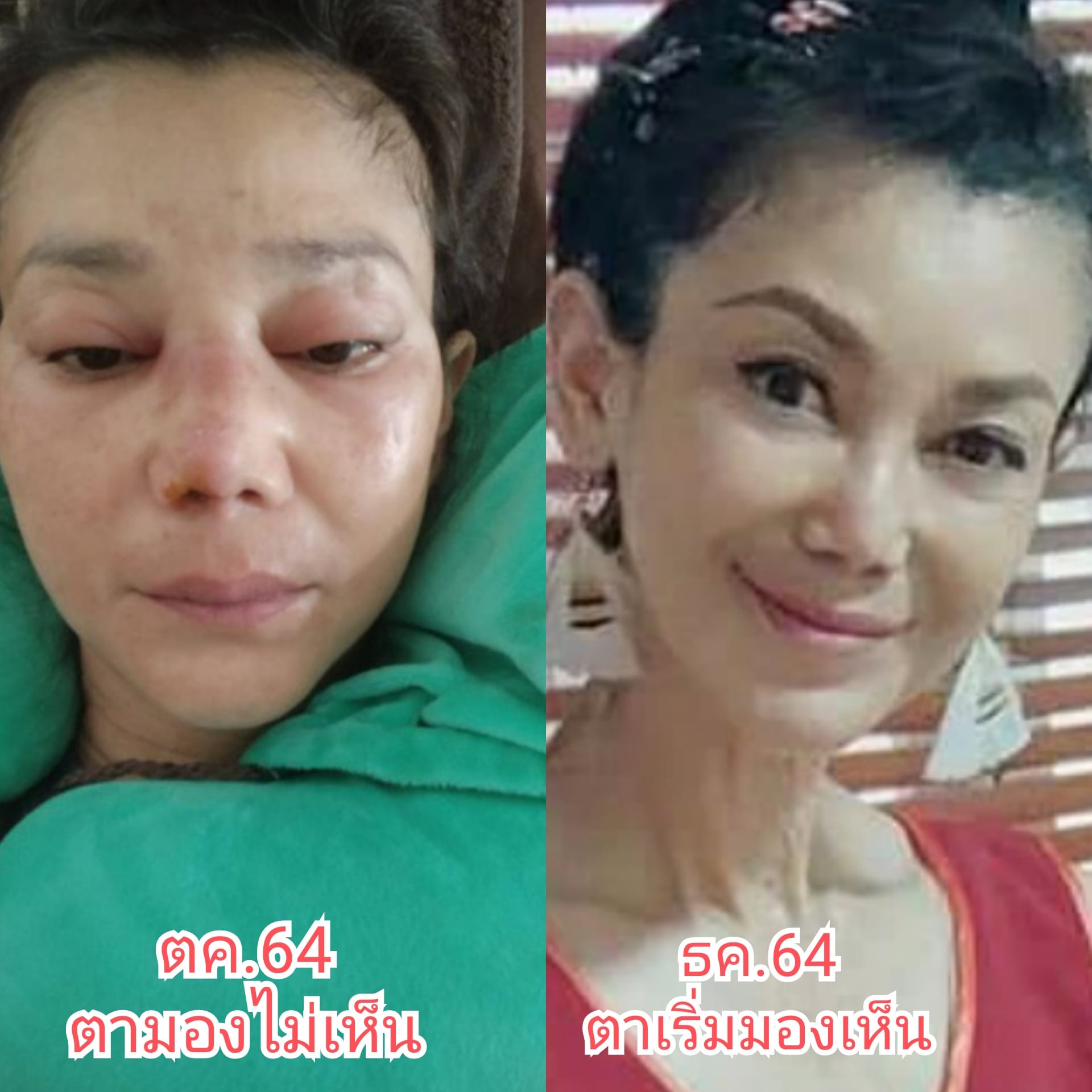 รอดตายครั้งล่าสุด!! อดีตดารา เอ๋ อัจฉรา หัวใจ-ไตวายเฉียบพลัน ทำ SLE มะเร็ง เบาหวานกำเริบ รอดตายครั้งล่าสุด!! อดีตดารา เอ๋ อัจฉรา หัวใจ-ไตวายเฉียบพลัน ทำ SLE มะเร็ง เบาหวานกำเริบ