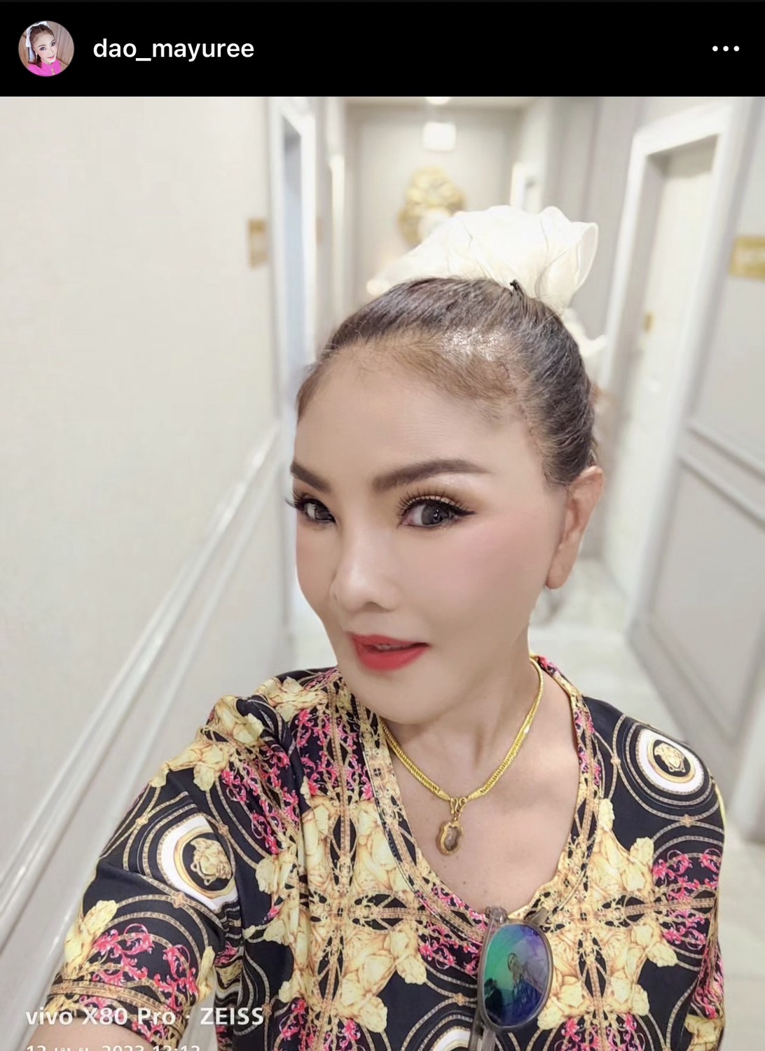 ตะลึงความสวย! ดาว มยุรี อัปเดตหน้าใหม่หลังทำศัลยกรรมครบ 14 วัน ตะลึงความสวย! ดาว มยุรี อัปเดตหน้าใหม่หลังทำศัลยกรรมครบ 14 วัน