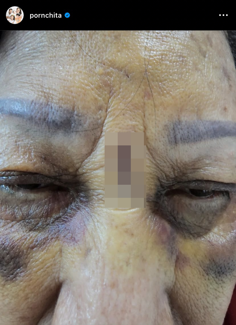 เบนซ์ พรชิตา แชร์อุทาหรณ์ คุณแม่เกิดอุบัติเหตุรถเข็นในห้างลากลงทางเลื่อน