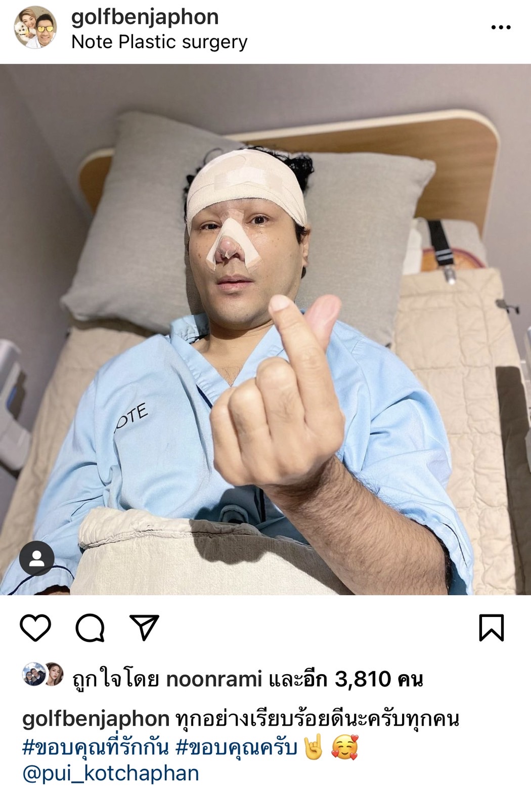 กอล์ฟ เบญจพล อัปเดตหลังเสริมหล่อ ถูกโทรศัพท์แกงหนัก จำหน้าไม่ได้?!  