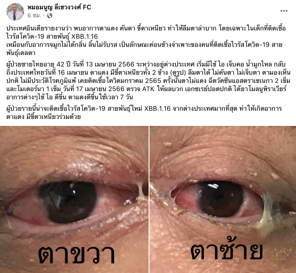หมอมนูญเผยป่วยตาแดงแบบไหน? อาจติดโควิดสายพันธุ์ XBB.1.16 หมอมนูญเผยป่วยตาแดงแบบไหน? อาจติดโควิดสายพันธุ์ XBB.1.16