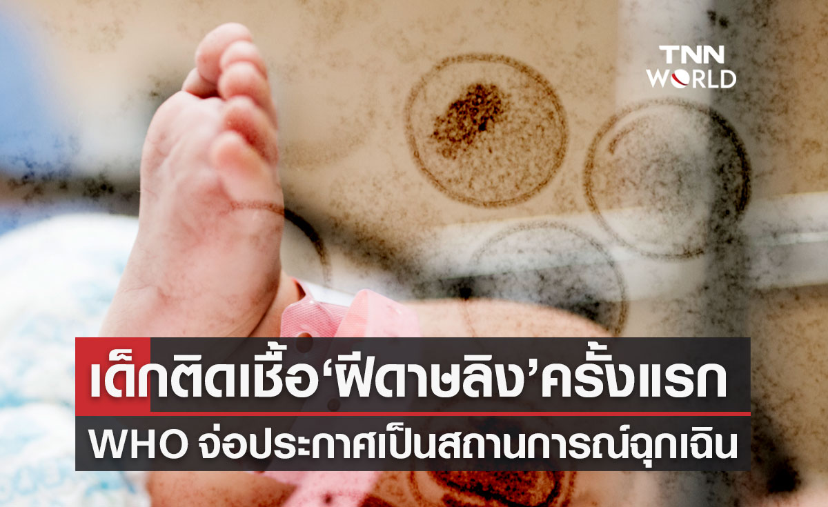 เด็กติดเชื้อ "ฝีดาษลิง" ครั้งแรก! WHO จ่อประกาศสถานการณ์ฉุกเฉินสาธารณสุข