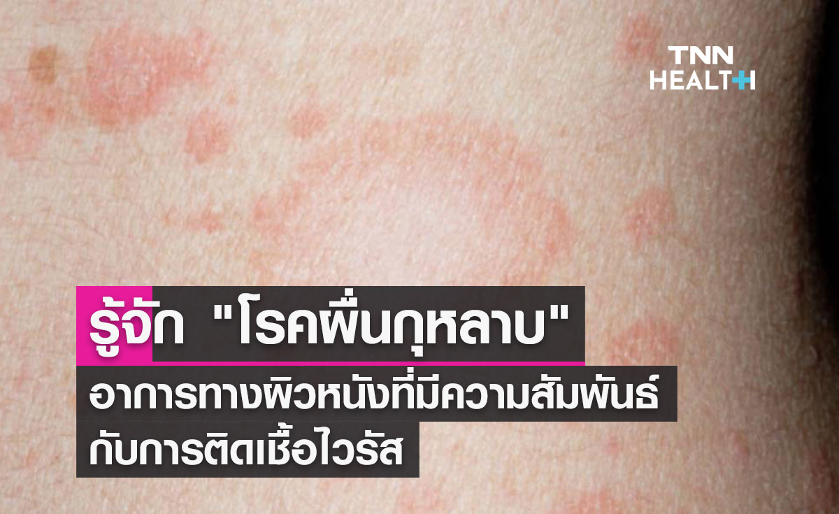 รู้จัก "โรคผื่นกุหลาบ" อาการทางผิวหนังที่มีความสัมพันธ์กับการติดเชื้อไวรัส