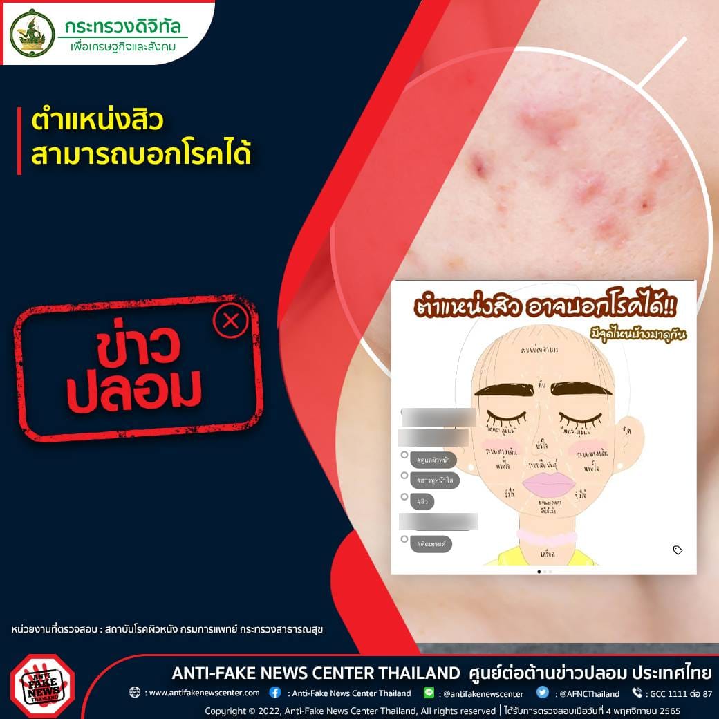 “ตำแหน่งสิว” บอกอาการป่วยของโรคได้ หมอผิวหนังตอบชัดจริงหรือไม่? “ตำแหน่งสิว” บอกอาการป่วยของโรคได้ หมอผิวหนังตอบชัดจริงหรือไม่?