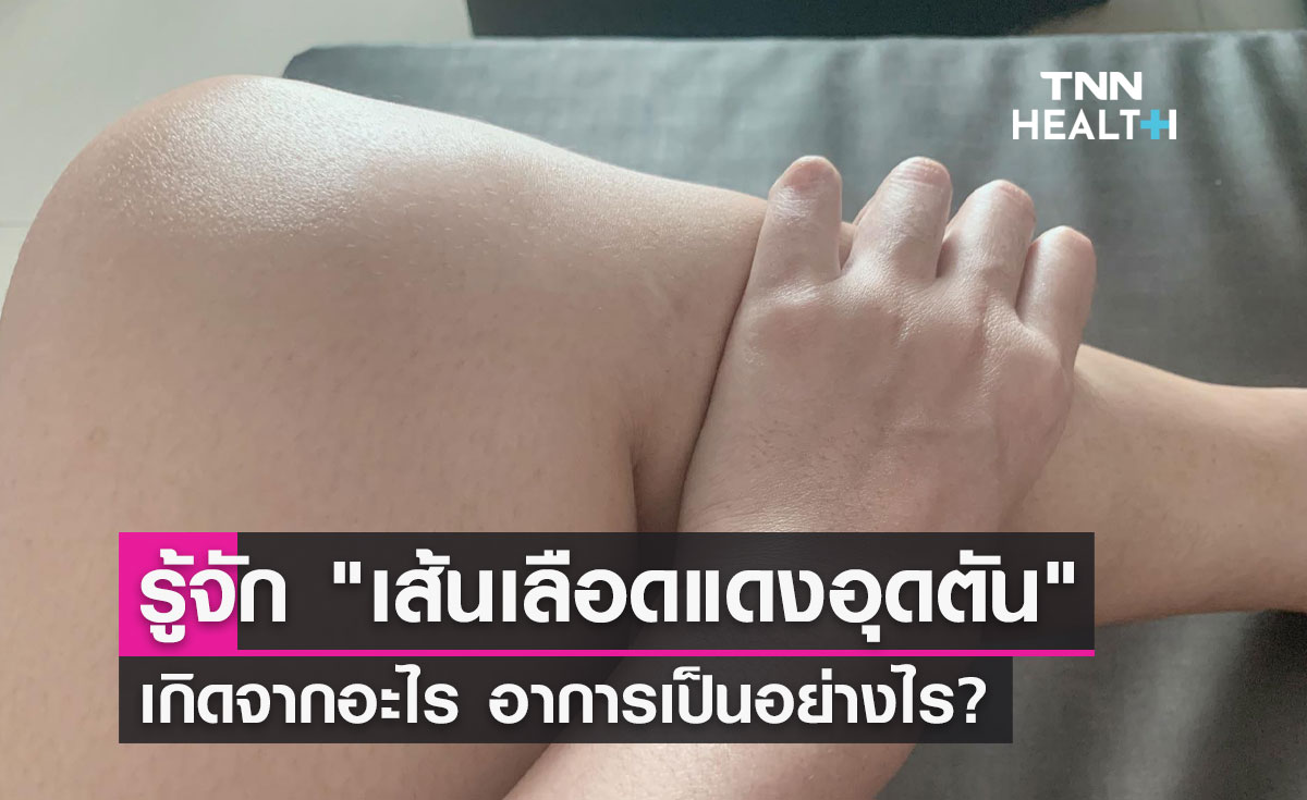 รู้จัก "เส้นเลือดแดงอุดตัน" เกิดจากอะไร อาการเป็นอย่างไร? 