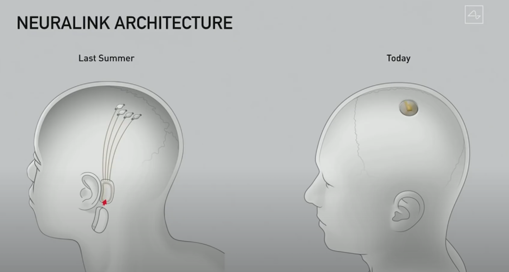 อัปเกรดสมอง วิวัฒนาการขั้นสุดยอดของมวลมนุษย์ ด้วยชิป Neuralink อัปเกรดสมอง วิวัฒนาการขั้นสุดยอดของมวลมนุษย์ ด้วยชิป Neuralink