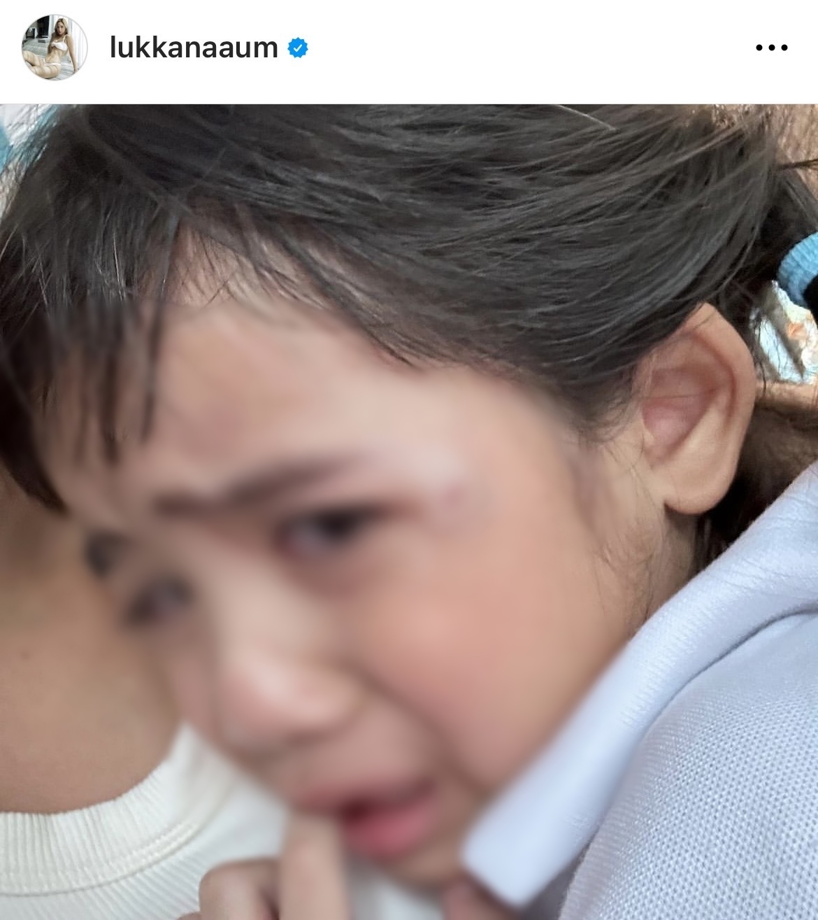 น้องดิสนีย์ ลูกสาว อุ้ม ลักขณา ได้รับบาดเจ็บ