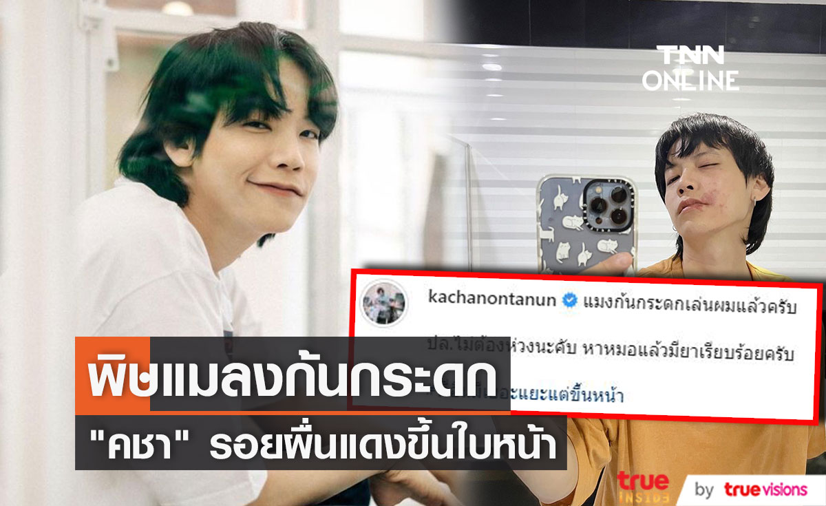 "คชา นนทนันท์" เจอพิษแมลงก้นกระดก ผื่นขึ้นบนใบหน้า