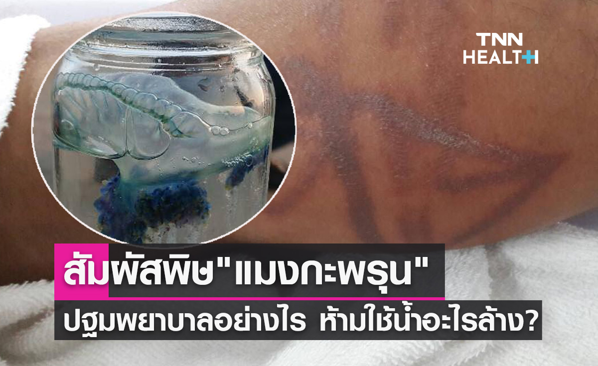 โดนพิษแมงกะพรุน แนะวิธีปฐมพยาบาล ห้ามใช้น้ำอะไรล้าง?