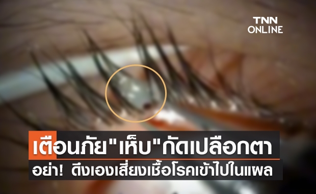 ขนลุก! คลินิกโพสต์คลิป "เห็บ" เกาะ-กัดเปลือกตา แนะไม่ควรดึงออกเอง