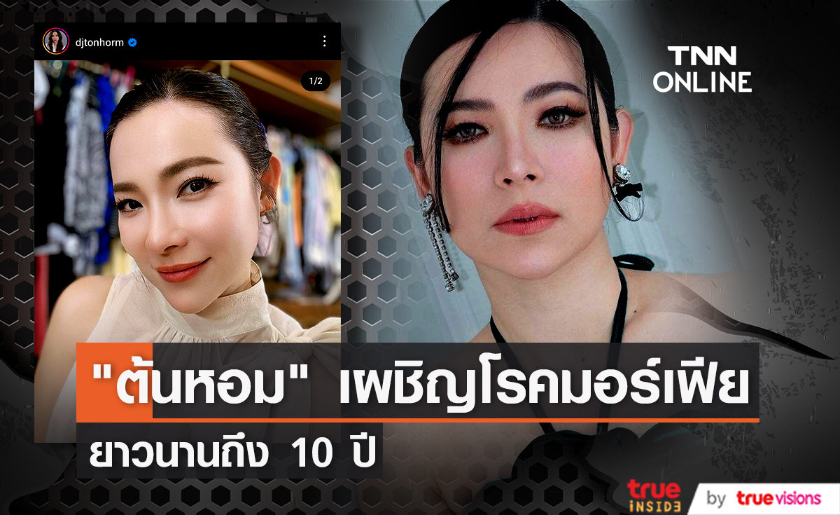 "ต้นหอม" เผชิญโรคผิวหนังนาน 10 ปี ที่พบได้เพียง 1 ใน 3 แสนคน