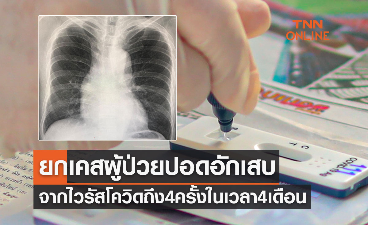 "หมอมนูญ" ยกเคสผู้ป่วยปอดอักเสบจากไวรัสโควิดถึง 4 ครั้งในเวลา 4 เดือน