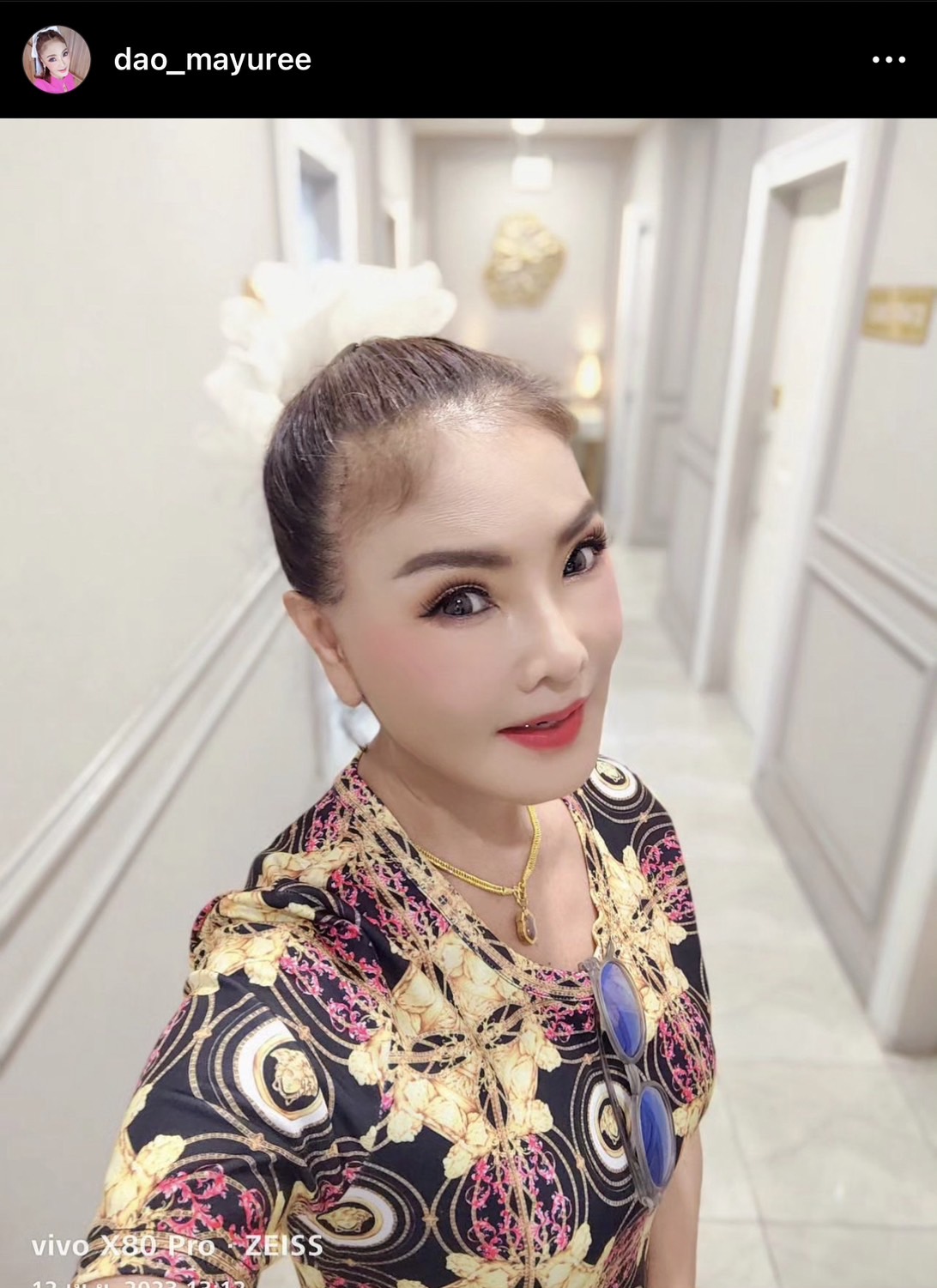 ตะลึงความสวย! ดาว มยุรี อัปเดตหน้าใหม่หลังทำศัลยกรรมครบ 14 วัน