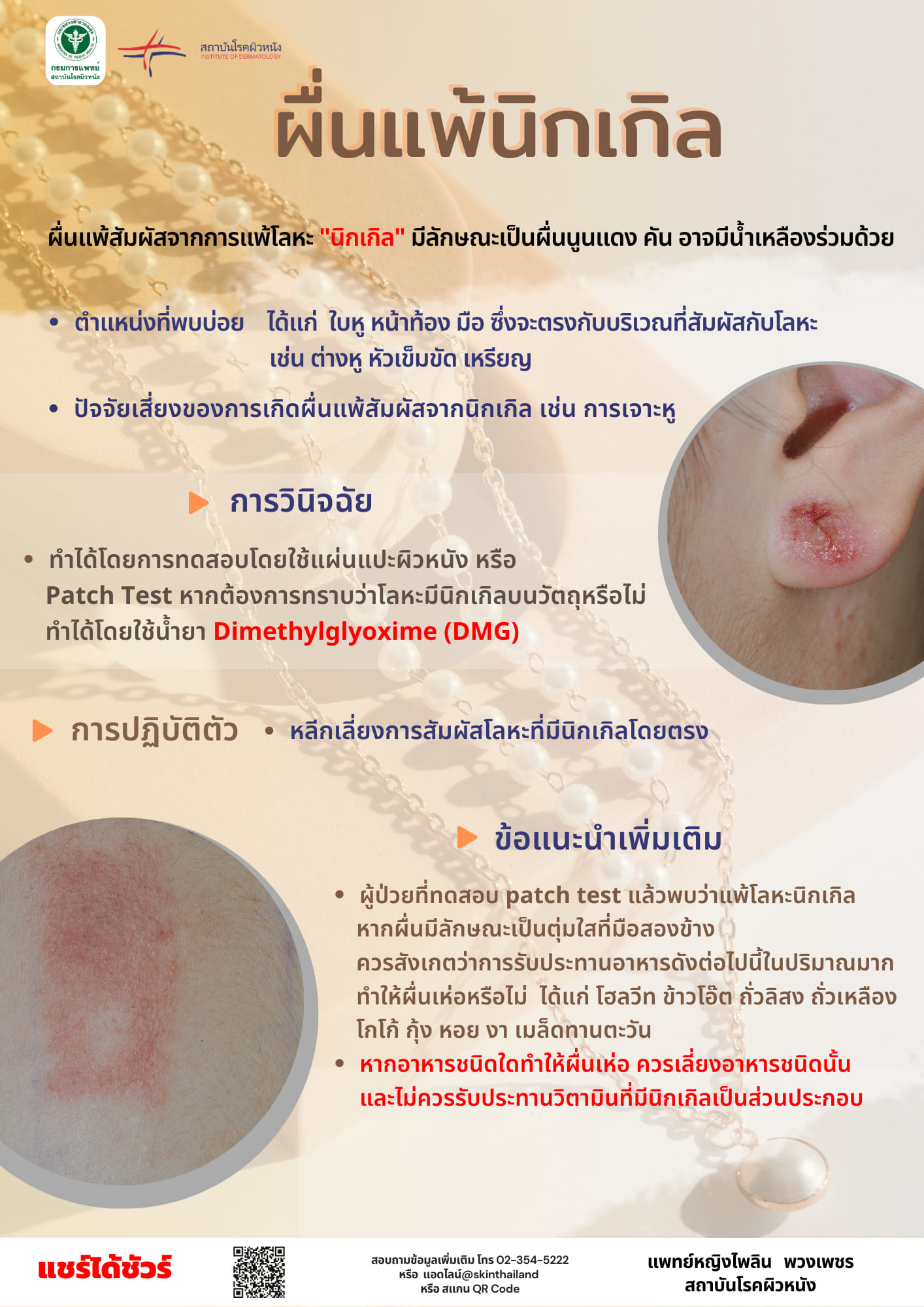 แพ้เครื่องประดับ “นิกเกิล” มีอาการอย่างไร-ป้องกันได้ด้วยวิธีนี้! 