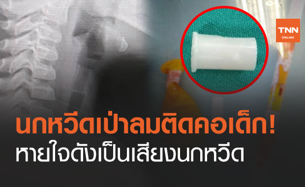 อุทาหรณ์! "นกหวีดเป่าลม" ติดหลอดลมเด็ก เกิดเสียงหวีดในลำคอทุกครั้งที่หายใจ