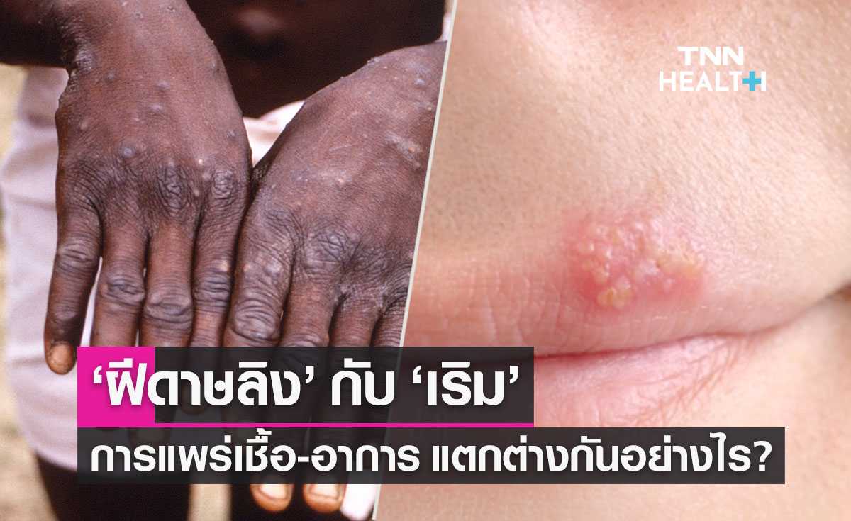 "โรคฝีดาษลิง" กับ "โรคเริม" การแพร่เชื้อ อาการ แตกต่างกันอย่างไร?