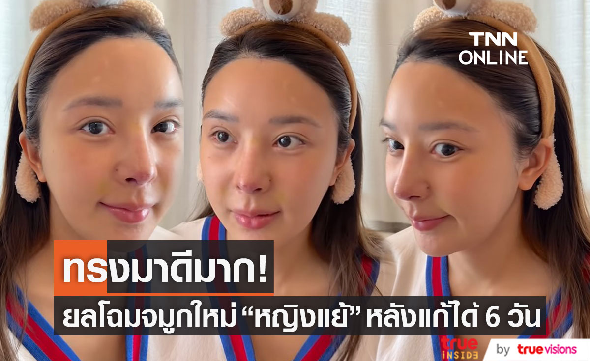 ทรงมาดี!! ยลโฉมจมูกใหม่ "หญิงแย้" หลังแก้ได้ 6 วัน