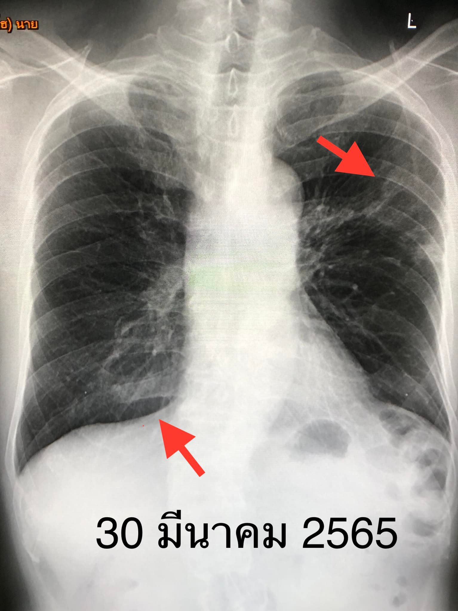 หมอมนูญเผยเคสน่าสนใจผู้ป่วยติดโควิด-เป็นวัณโรคในเวลาเดียวกัน หมอมนูญเผยเคสน่าสนใจผู้ป่วยติดโควิด-เป็นวัณโรคในเวลาเดียวกัน