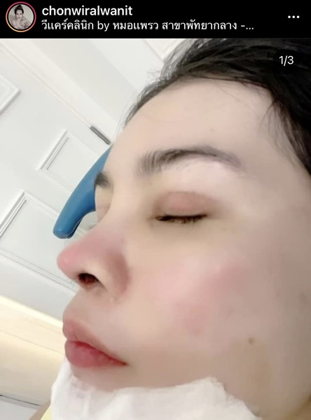 เอ๋ มิรา อัพความสวย ศัลยกรรมจมูก ตา และคาง เอ๋ มิรา อัพความสวย ศัลยกรรมจมูก ตา และคาง