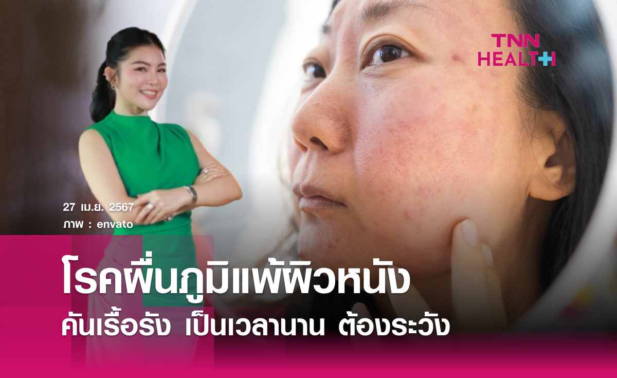 โรคผื่นภูแพ้ผิวหนัง (Atopic Dermatitis) : รู้จัก สาเหตุ อาการ และวิธีรักษา