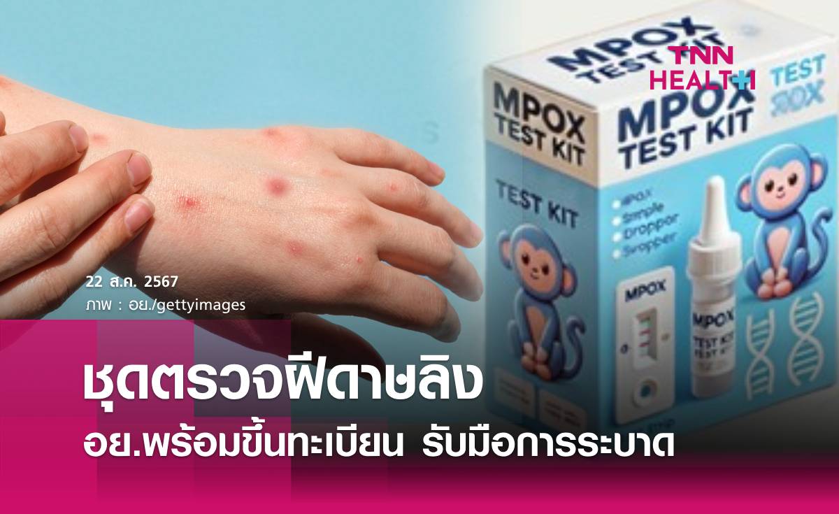 อย.พร้อมขึ้นทะเบียนชุดตรวจวินิจฉัยการติดเชื้อก่อโรคฝีดาษลิง