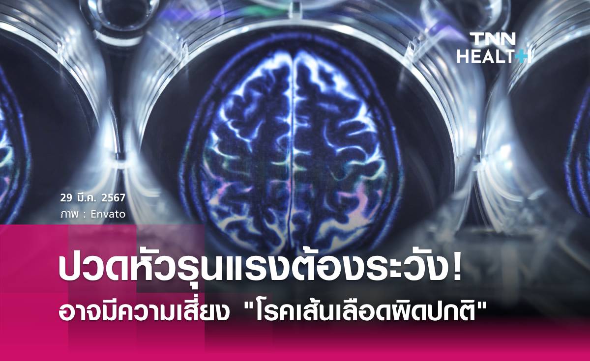 ปวดหัวรุนแรงต้องระวัง! "โรคเส้นเลือดผิดปกติ"