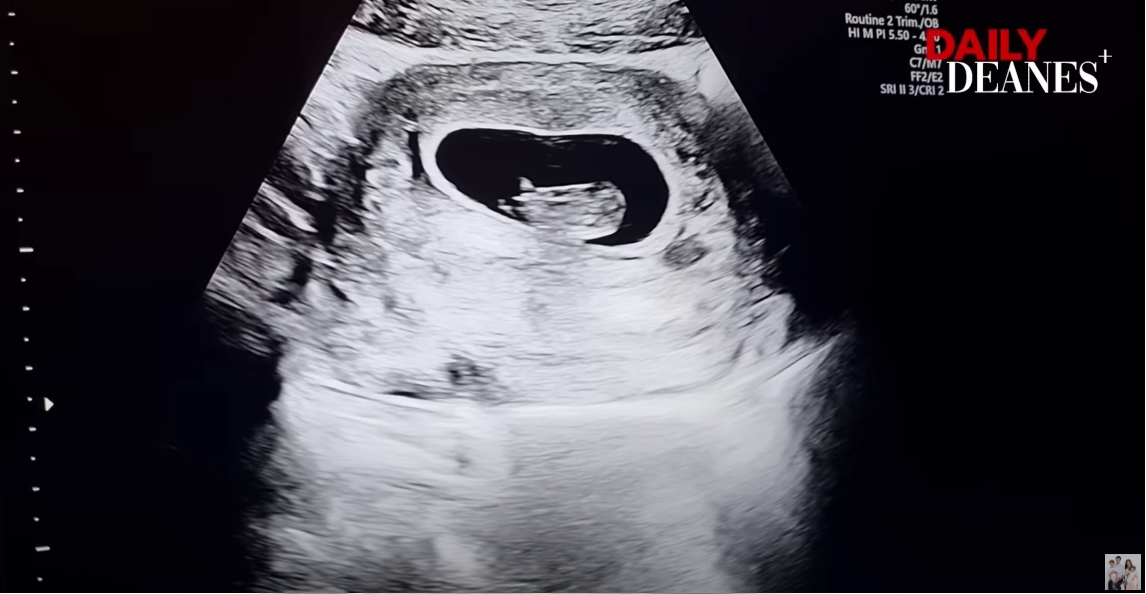  ลีเดีย เฉลยแล้ว! ภาพอัลตร้าซาวด์นั้นที่แท้เป็นลูกของน้องชาย 