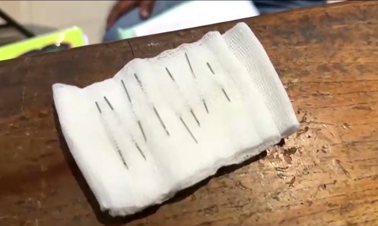 ผ่าตัดช่วยชีวิต! เด็กชายเปรูวัย 2 ขวบกลืนเข็มฉีดยา 8 เล่มลงท้อง