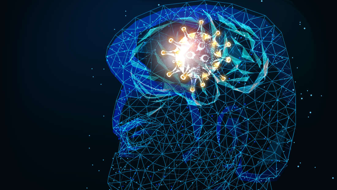 นักวิทยาศาสตร์พบความเชื่อมโยง โควิด-19 แม้หายป่วยแล้ว อาจทำให้เกิดโรคพาร์กินสันในอนาคต