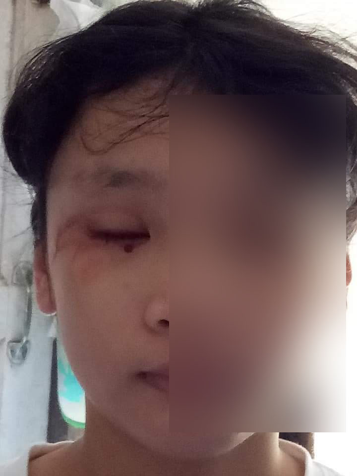 แม่โพสต์อุทาหรณ์! ลูกสาวเรียนออนไลน์-เล่นโทรศัพท์ เลือดออกในตา