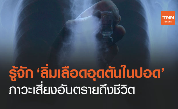 รู้จัก ‘ภาวะลิ่มเลือดอุดตันในปอด’ เสี่ยงอันตรายถึงชีวิต