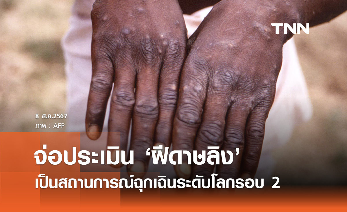 WHO จ่อประเมิน "ฝีดาษลิง" เป็นสถานการณ์ฉุกเฉินระดับโลกรอบ 2 หรือไม่