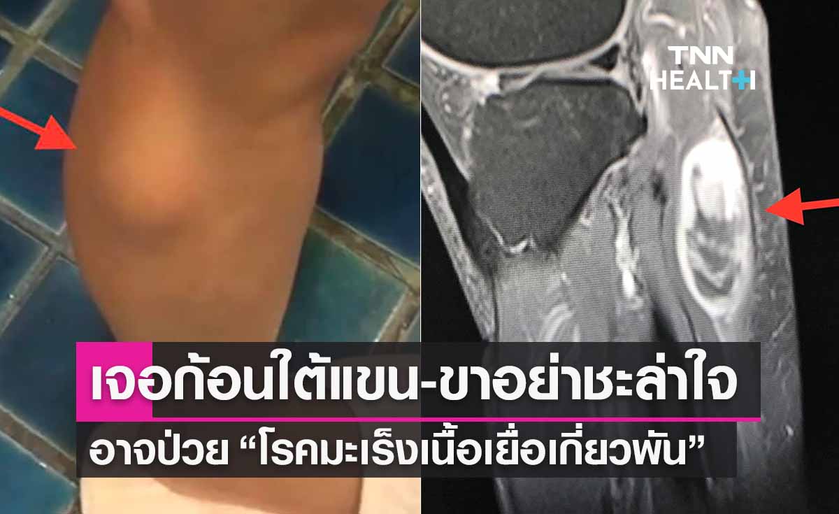คลำเจอก้อนใต้แขน-ขาอย่าชะล่าใจ! อาจป่วย “โรคมะเร็งเนื้อเยื่อ”