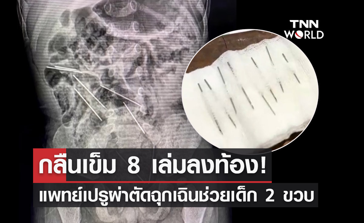 ผ่าตัดช่วยชีวิต! เด็กชายเปรูวัย 2 ขวบ "กลืนเข็ม 8 เล่ม" ลงท้อง