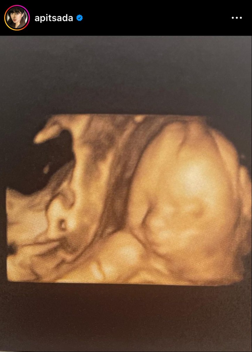 ไอซ์ อภิษฎา ตื่นเต้น จะได้เห็นหน้าลูกสาวแล้ว พร้อมถาม FC ว่าชื่ออะไรดี? ไอซ์ อภิษฎา ตื่นเต้น จะได้เห็นหน้าลูกสาวแล้ว พร้อมถาม FC ว่าชื่ออะไรดี?