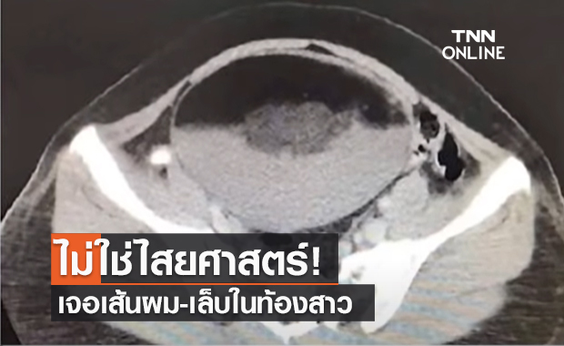 (คลิป) ไม่ใช่ไสยศาสตร์! เจอเส้นผม-เล็บในท้องสาว