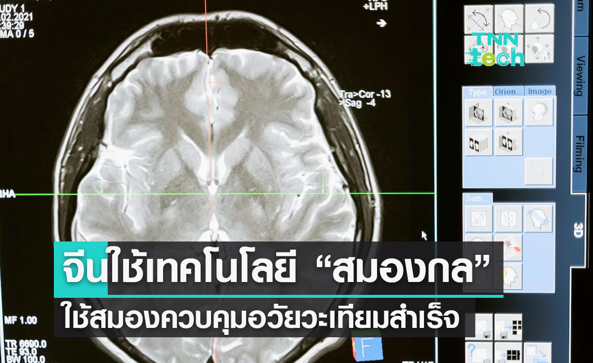 จีนเผยใช้เทคโนโลยี "สมองกล​" ใช้ความคิดควบคุมอวัยวะเทียมสำเร็จครั้งแรกของโลก