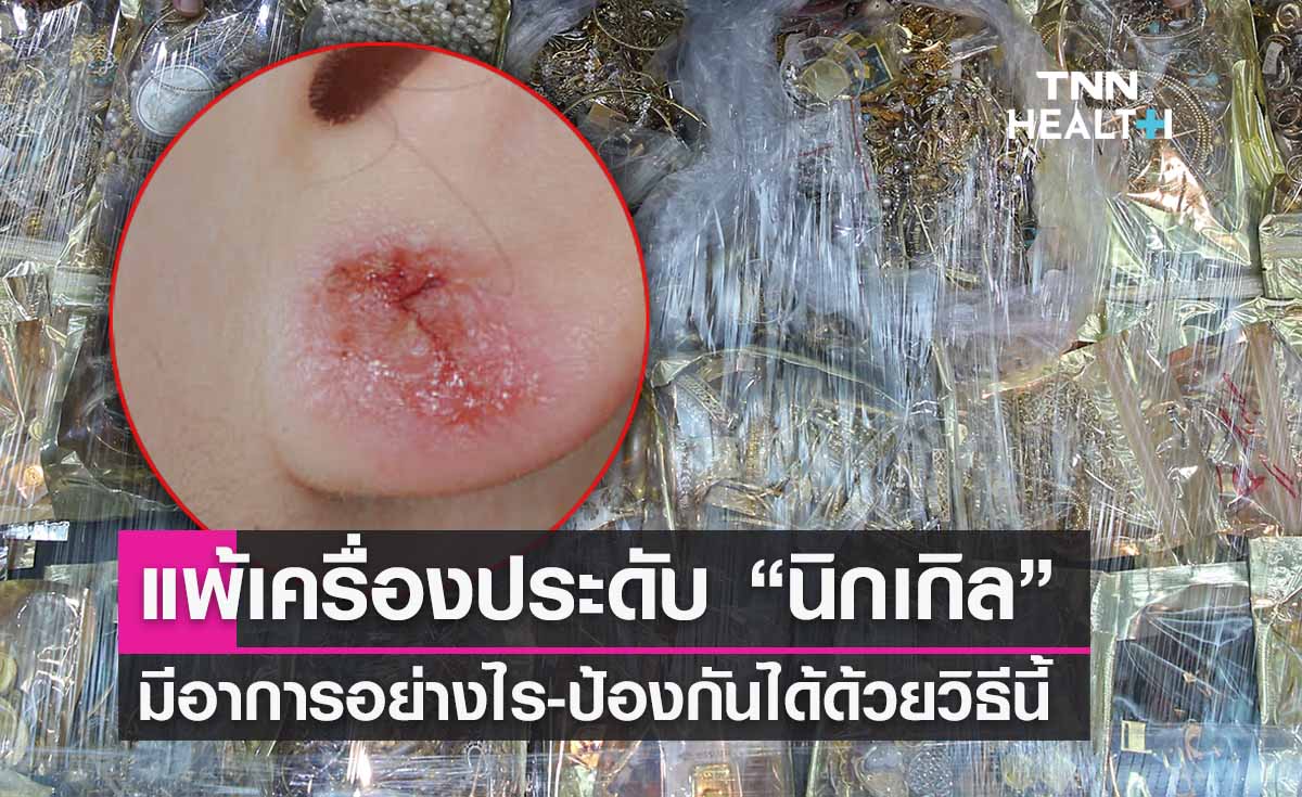 แพ้เครื่องประดับ “นิกเกิล” มีอาการอย่างไร-ป้องกันได้ด้วยวิธีนี้! 