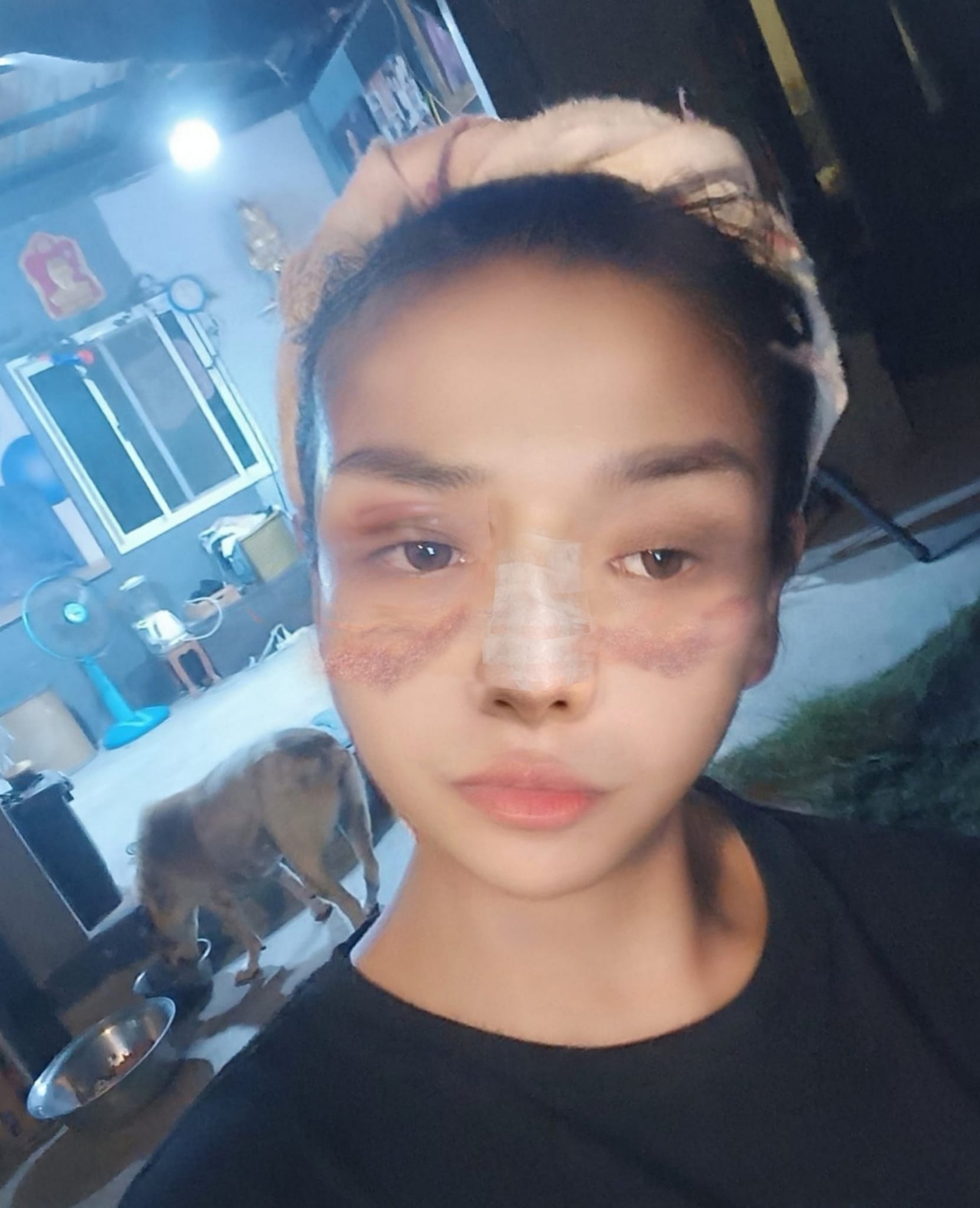 จมูกใหม่สวยมาก ยุ้ย ญาติเยอะ อัปเดตอาการหลังขึ้นเขียงทำศัลยกรรม ทำเอาจำแทบไม่ได้