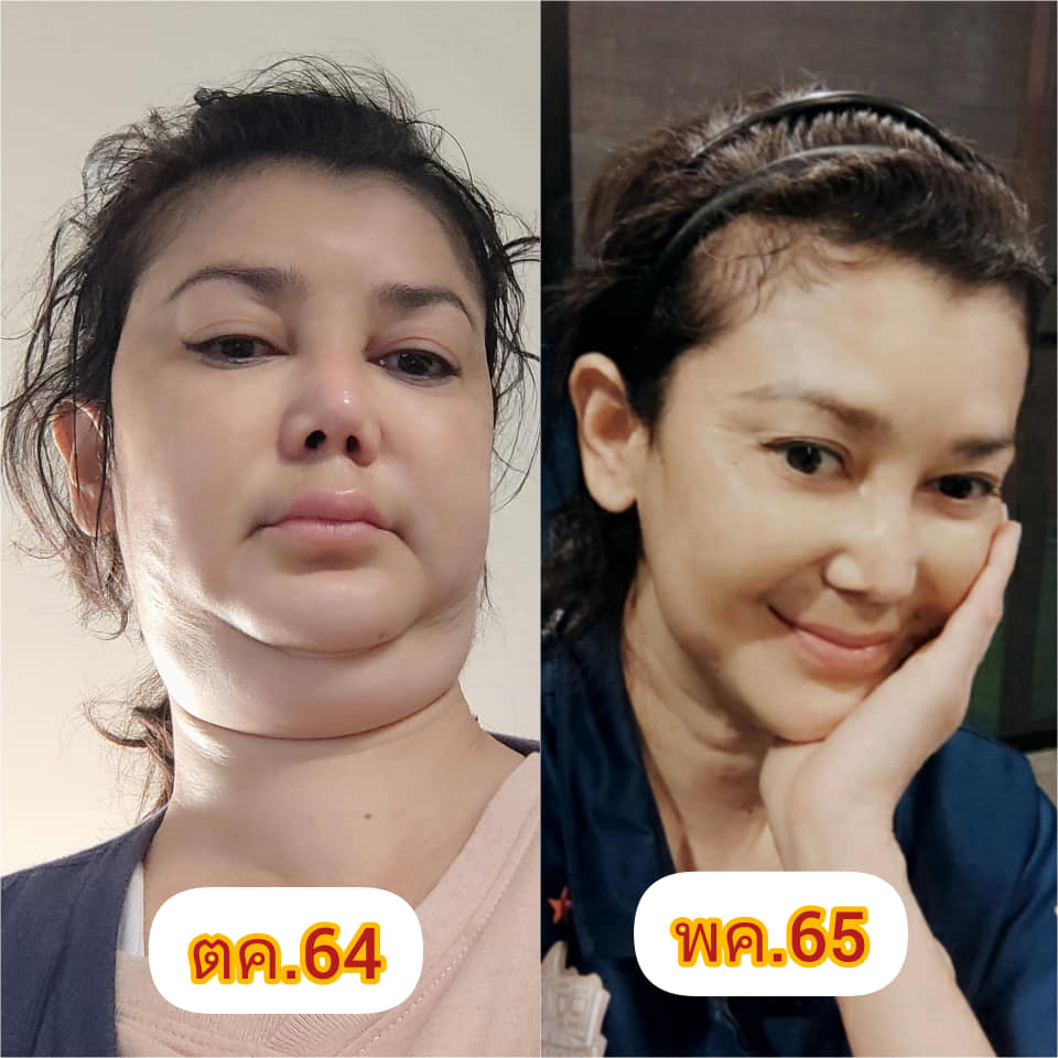 รอดตายครั้งล่าสุด!! อดีตดารา เอ๋ อัจฉรา หัวใจ-ไตวายเฉียบพลัน ทำ SLE มะเร็ง เบาหวานกำเริบ