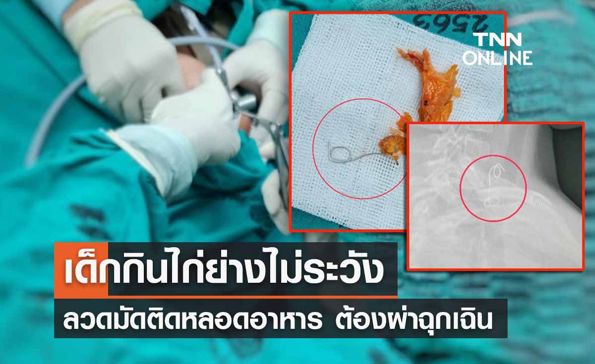 เคสอุทาหรณ์! เด็กกินไก่ย่างไม่ระวัง ลวดมัดติดหลอดอาหาร ต้องผ่าตัดด่วน